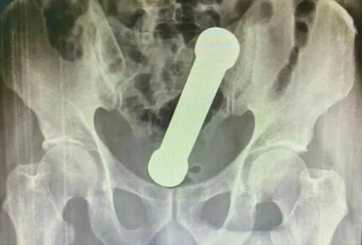 saude Médicos encontram halter de 2 quilos dentro de paciente