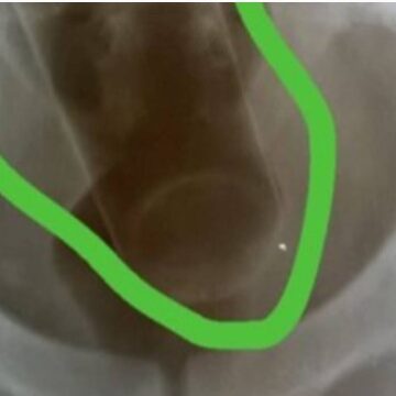 Captura de tela 2025-02-12 161546 Médico que vazou raio-X de paciente que inseriu desodorante no ânus é demitido SAIBA MAIS :