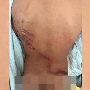 RAIO: “Pensei que ia morrer”: adolescente é gravemente ferido por raio durante ato de Nikolas em defesa de Bolsonaro